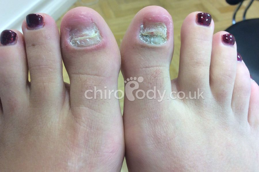 Toenail Reconstruction Cosmetic Podiatry Treatments Chiropody co 