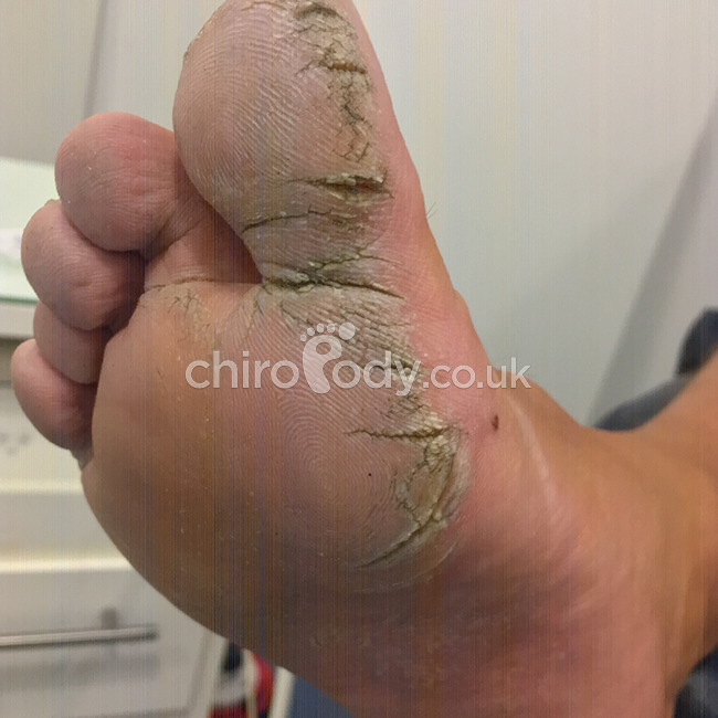 https://www.chiropody.co.uk/images/before-and-after/dry-skin-treatment/2a.png